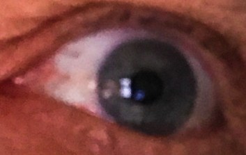eyeball